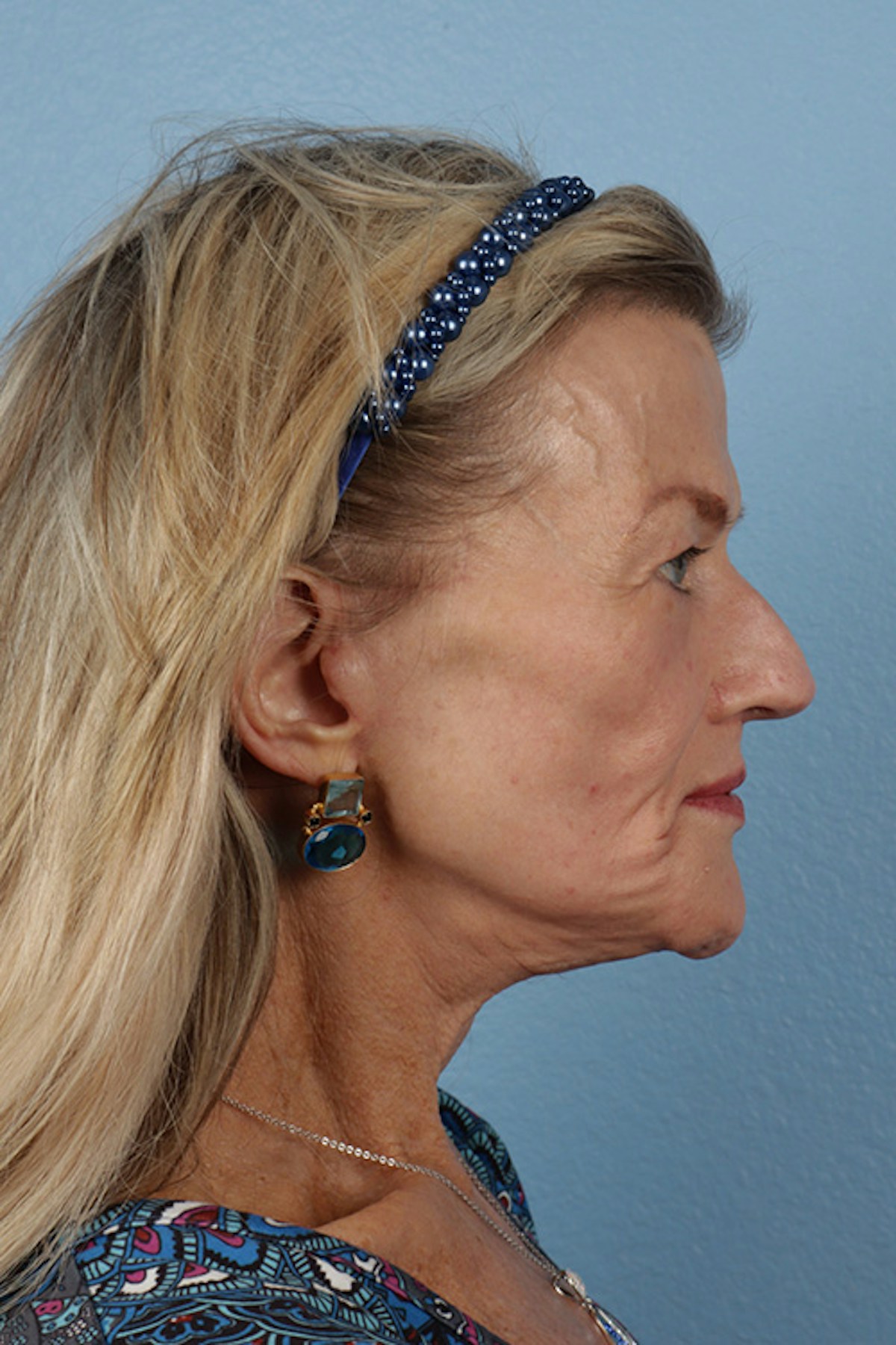 Fat Transfer Before & After Gallery - Patient 304134 - Image 6