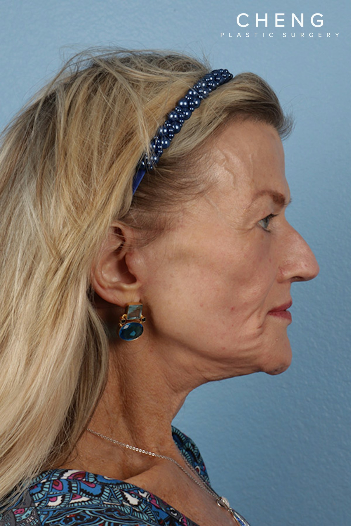 Hidden Patients Before & After Gallery - Patient 277659 - Image 6