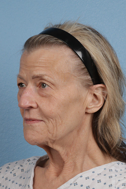 Hidden Patients Before & After Gallery - Patient 277659 - Image 7