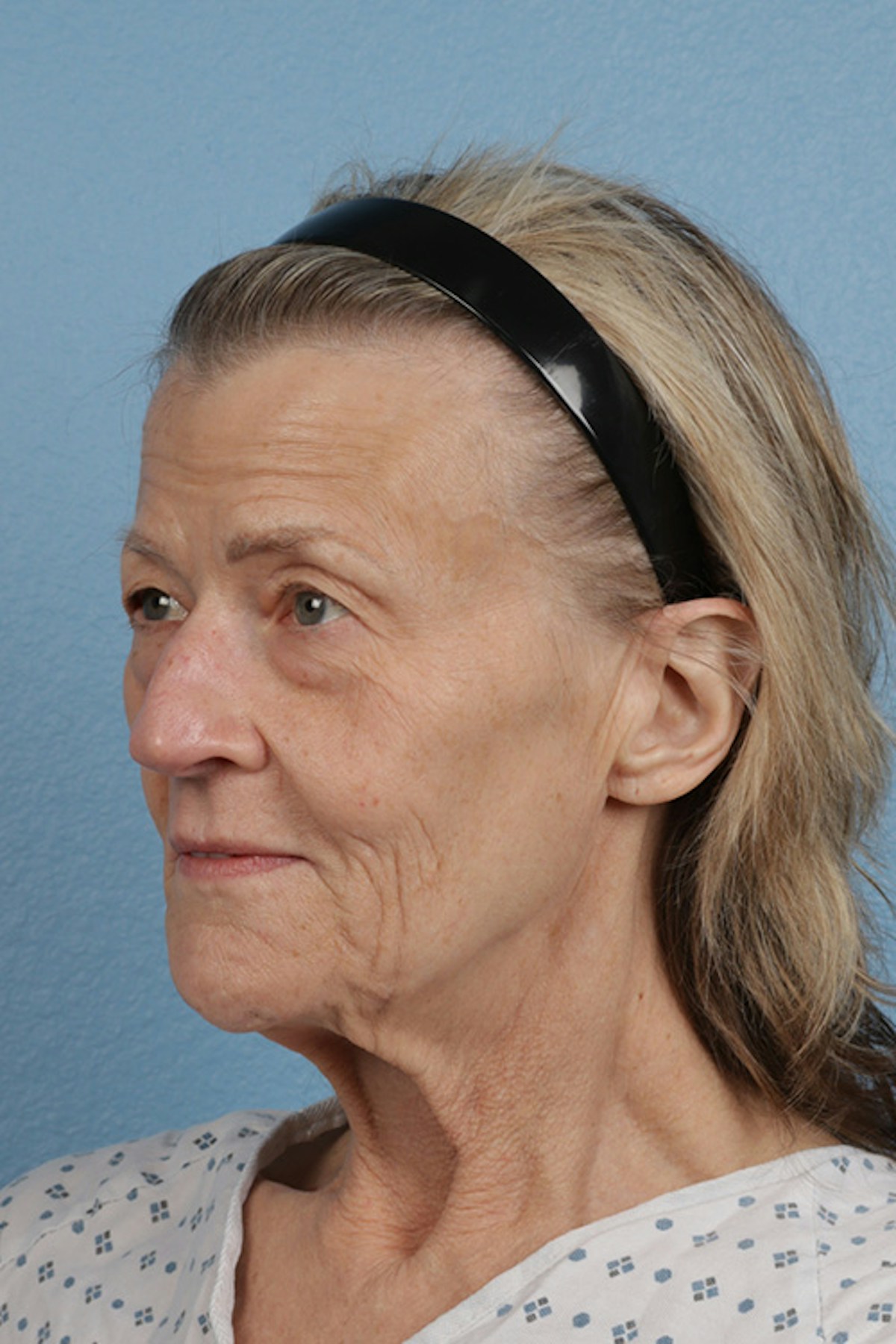 Fat Transfer Before & After Gallery - Patient 304134 - Image 7