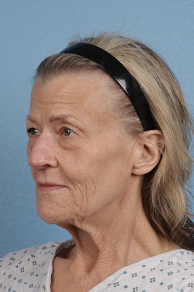 Lip Lift Before & After Gallery - Patient 340858 - Image 1