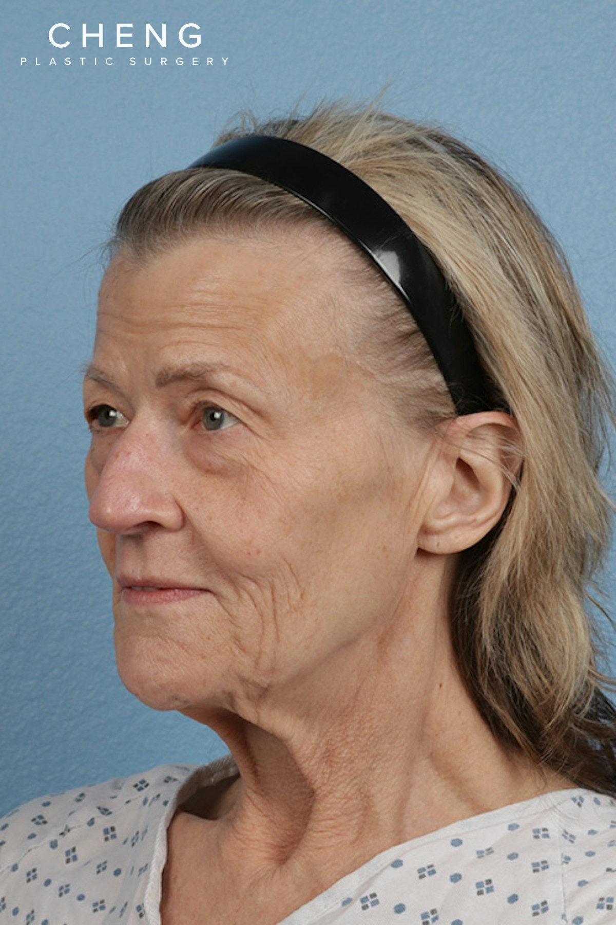 Hidden Patients Before & After Gallery - Patient 277659 - Image 7