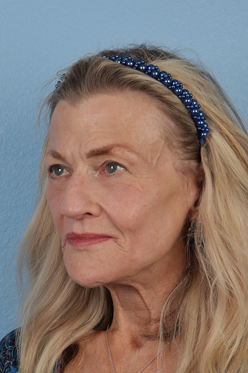 Hidden Patients Before & After Gallery - Patient 277659 - Image 8