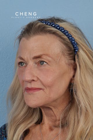 Hidden Patients Before & After Gallery - Patient 315045 - Image 8