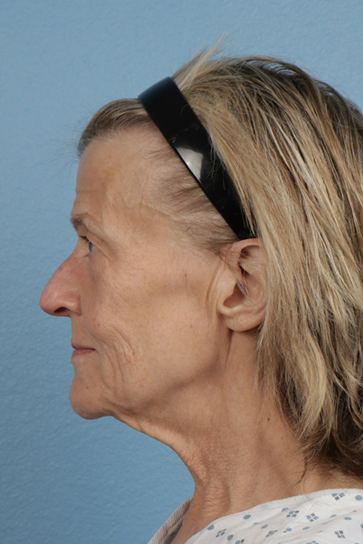 Fat Transfer Before & After Gallery - Patient 304134 - Image 9