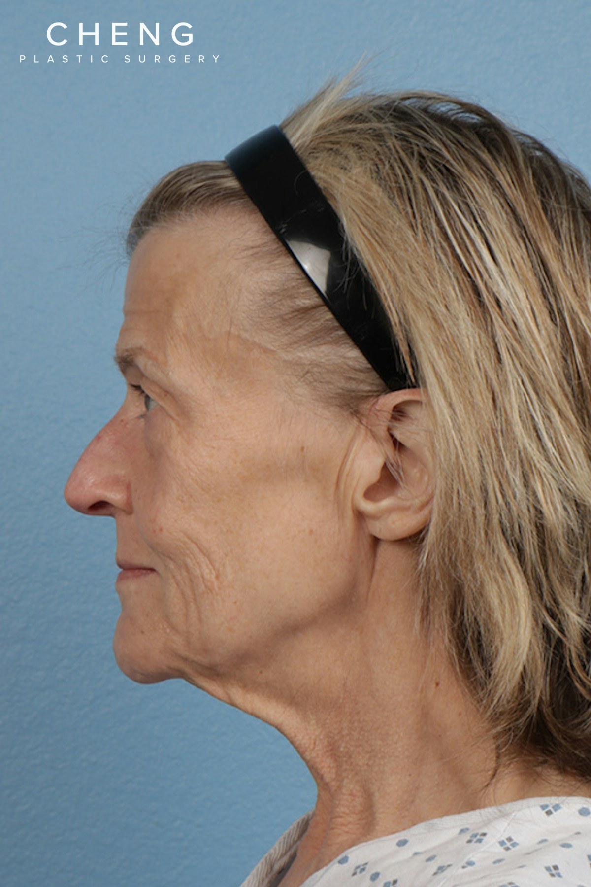 Hidden Patients Before & After Gallery - Patient 277659 - Image 9