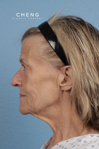 Hidden Patients Before & After Gallery - Patient 315045 - Image 9