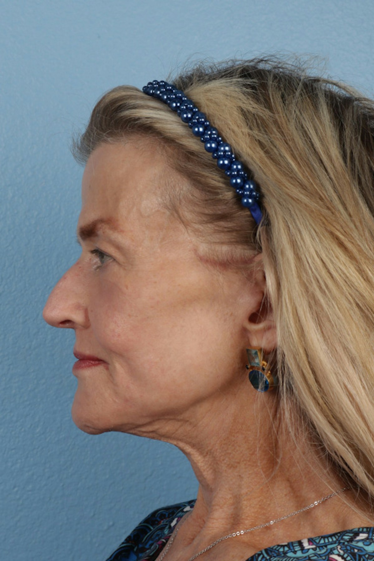 Fat Transfer Before & After Gallery - Patient 304134 - Image 10