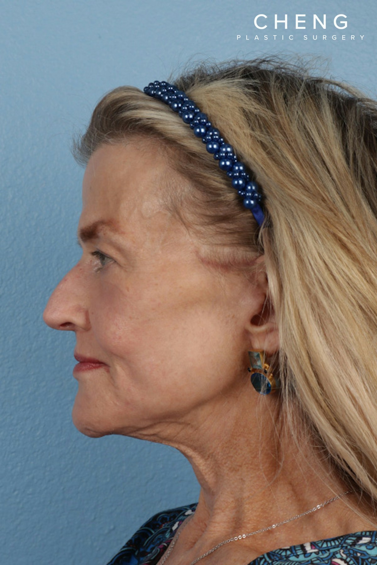 Hidden Patients Before & After Gallery - Patient 277659 - Image 10