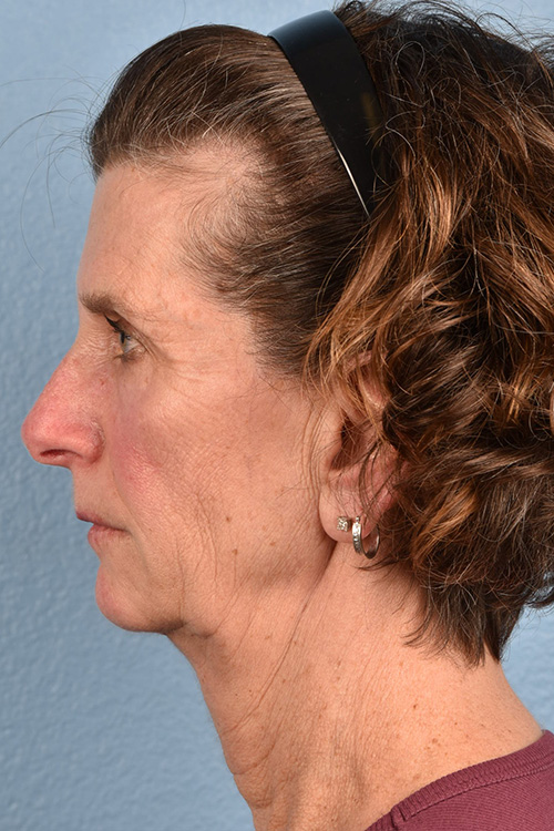 Neck Lift Before & After Gallery - Patient 180677 - Image 1
