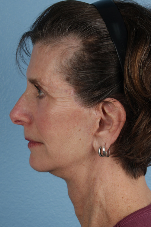 Neck Lift Before & After Gallery - Patient 180677 - Image 2