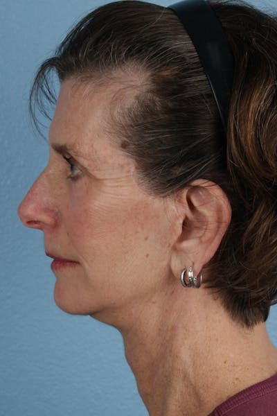 Facelift Before & After Gallery - Patient 307064 - Image 2