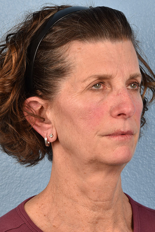 Neck Lift Before & After Gallery - Patient 180677 - Image 3