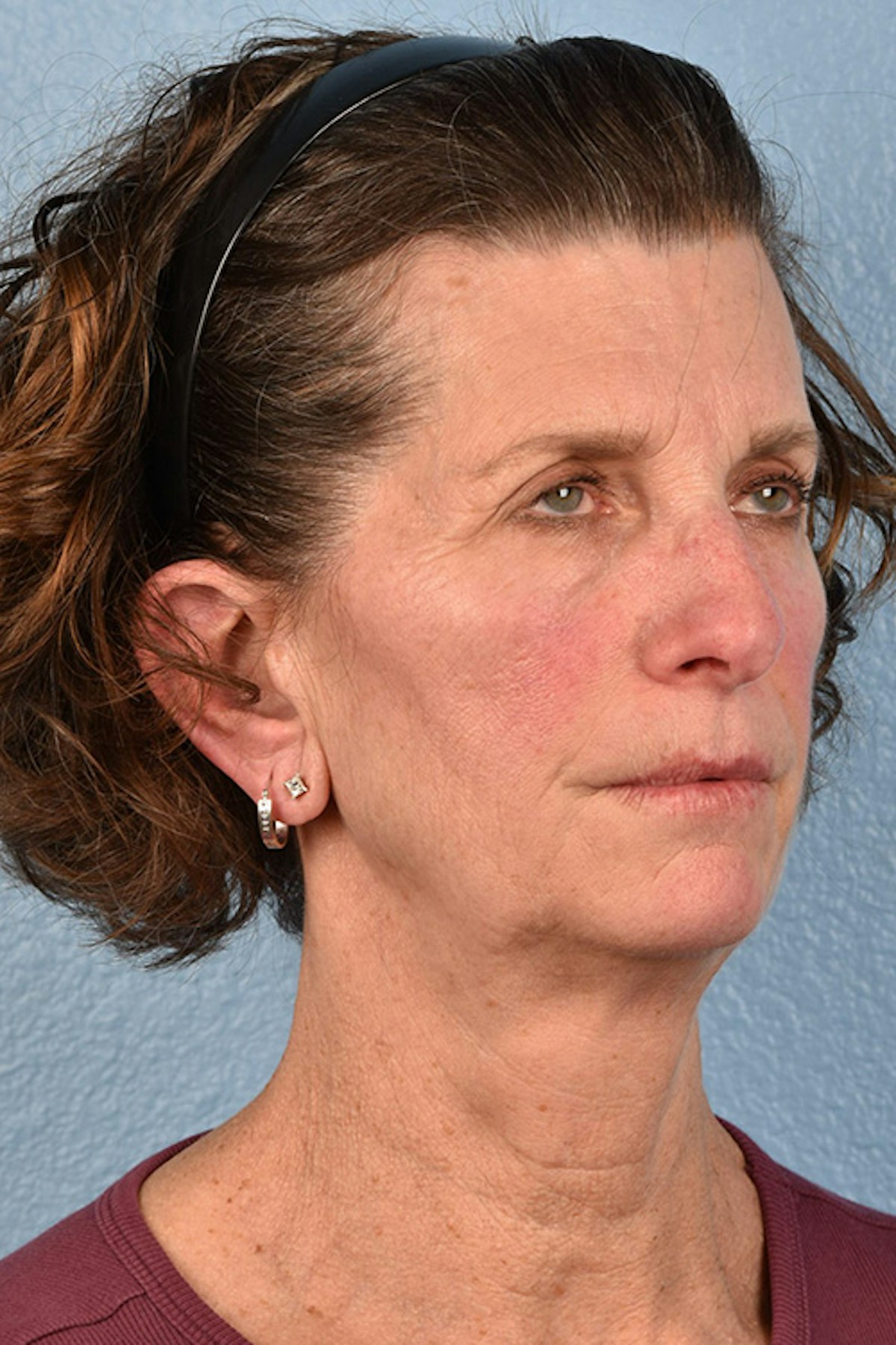 Facelift Before & After Gallery - Patient 307064 - Image 3