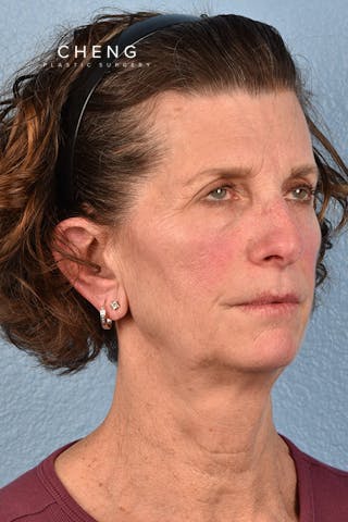 Hidden Patients Before & After Gallery - Patient 414780 - Image 3