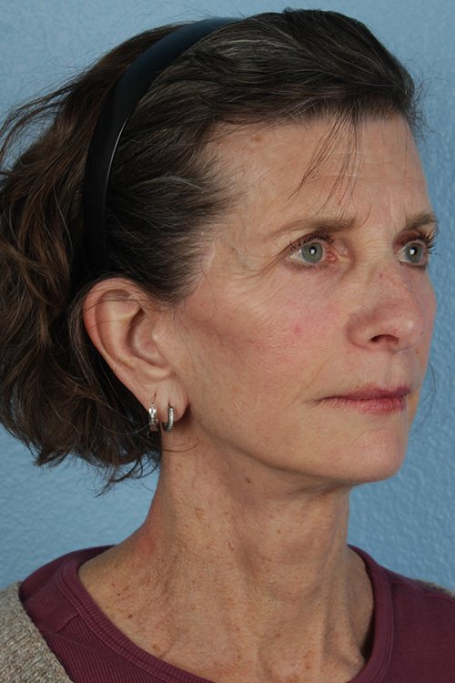 Neck Lift Before & After Gallery - Patient 180677 - Image 4