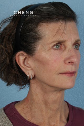 Hidden Patients Before & After Gallery - Patient 414780 - Image 4