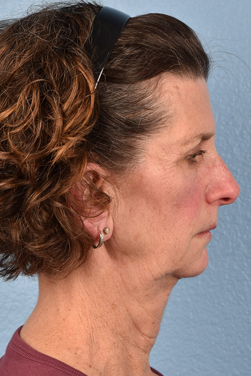 Neck Lift Before & After Gallery - Patient 180677 - Image 5