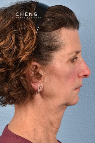 Hidden Patients Before & After Gallery - Patient 414780 - Image 5