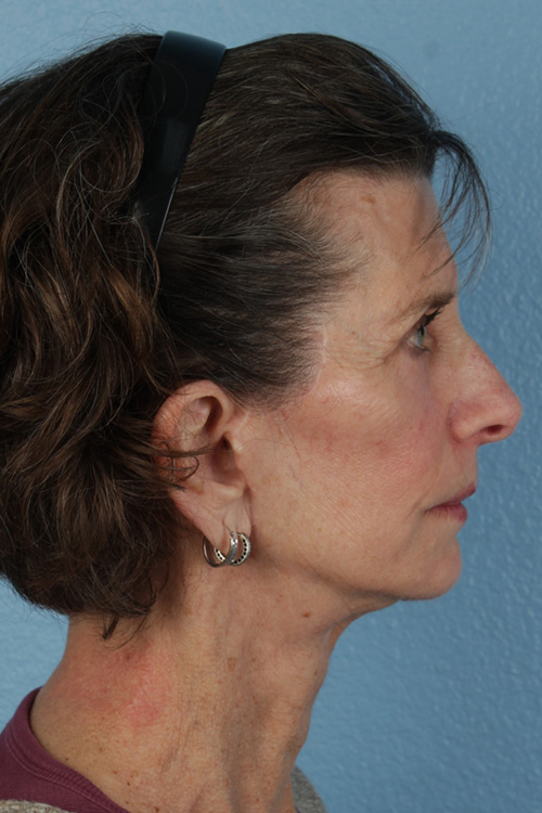 Neck Lift Before & After Gallery - Patient 180677 - Image 6
