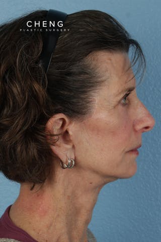 Hidden Patients Before & After Gallery - Patient 414780 - Image 6