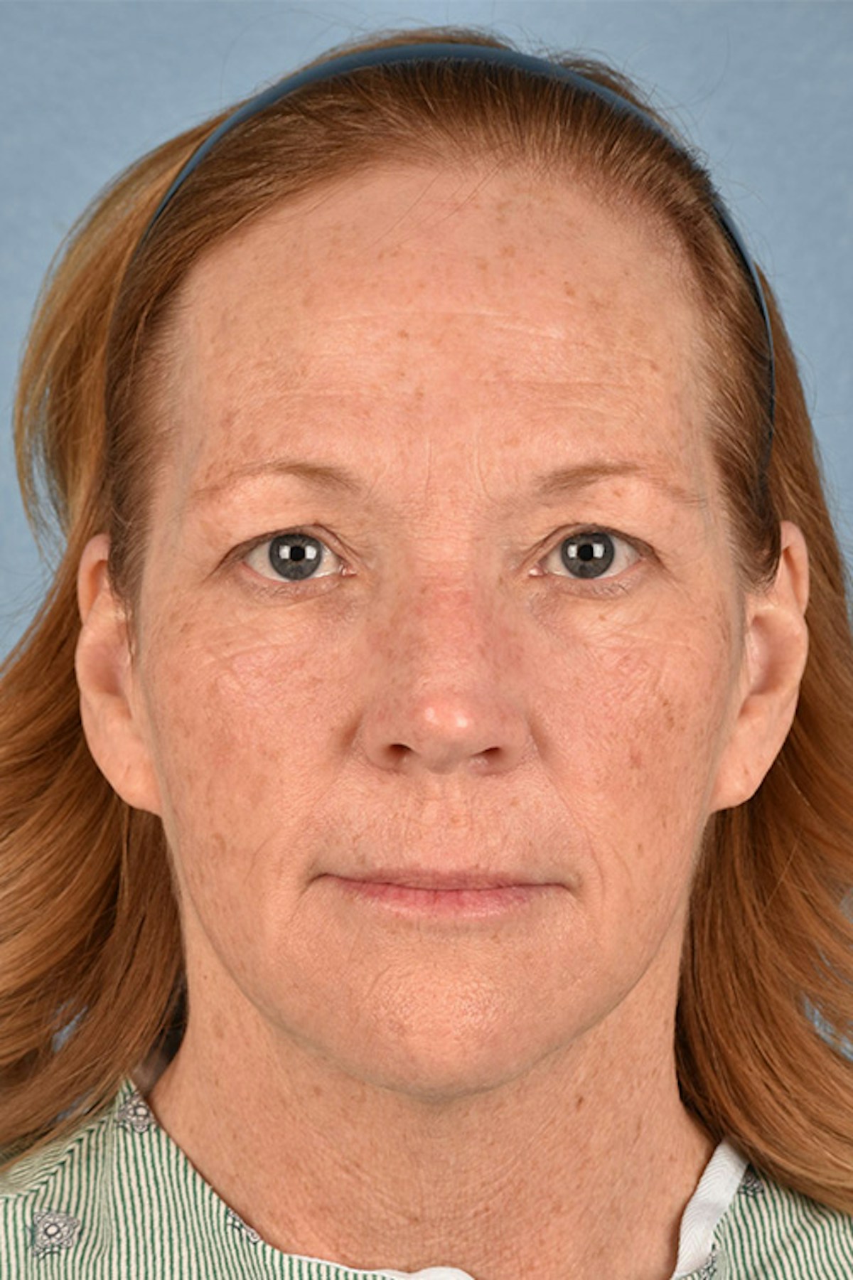 Blepharoplasty Before & After Gallery - Patient 943759 - Image 1