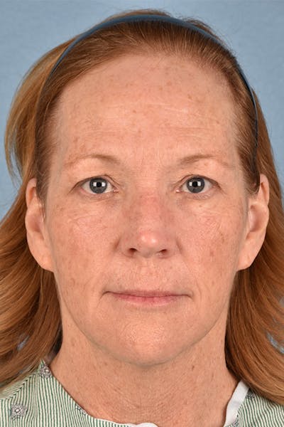 Blepharoplasty Before & After Gallery - Patient 943759 - Image 1