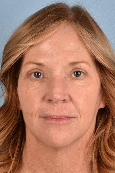 Blepharoplasty Before & After Gallery - Patient 943759 - Image 2