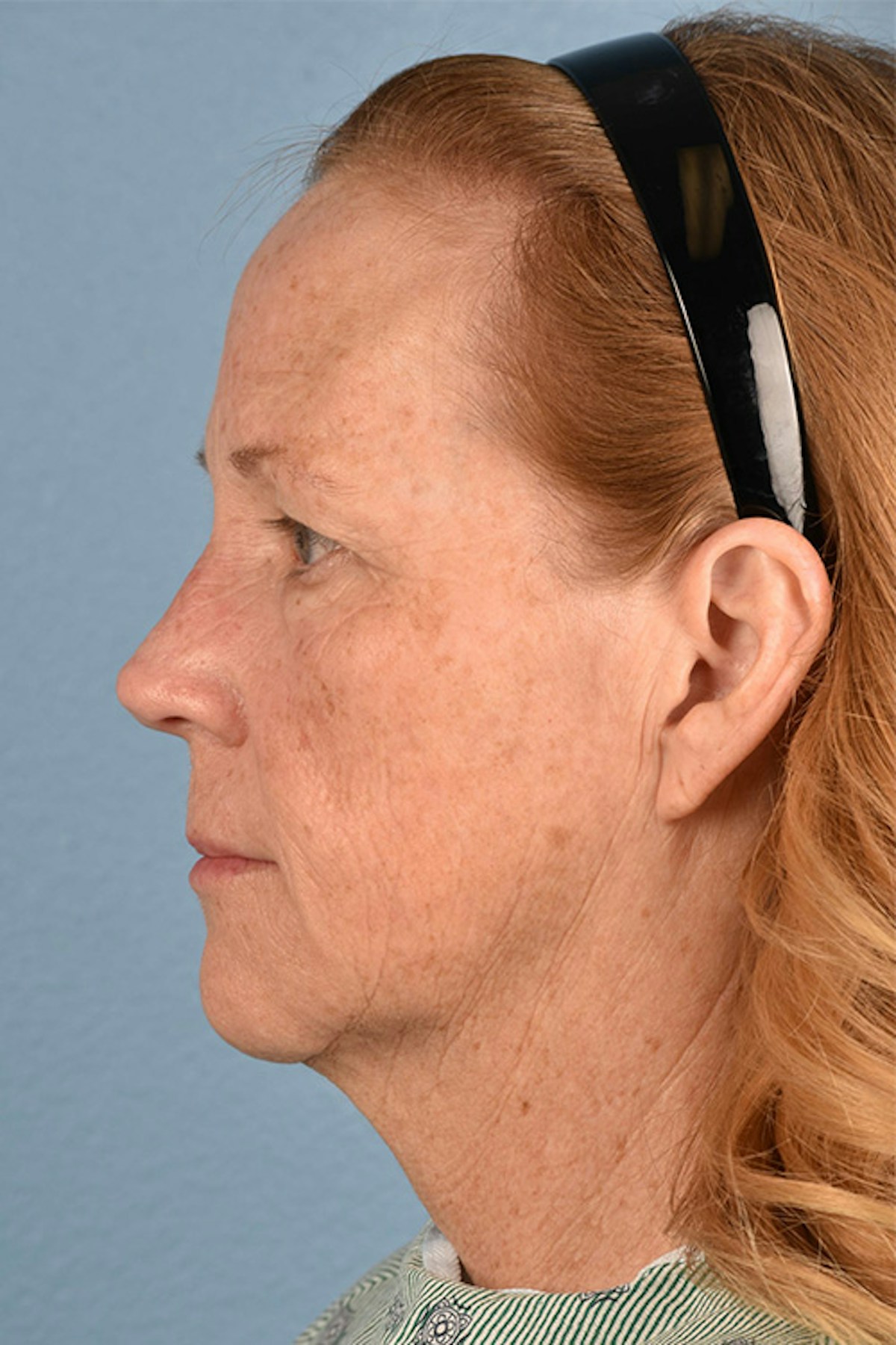 Blepharoplasty Before & After Gallery - Patient 943759 - Image 3