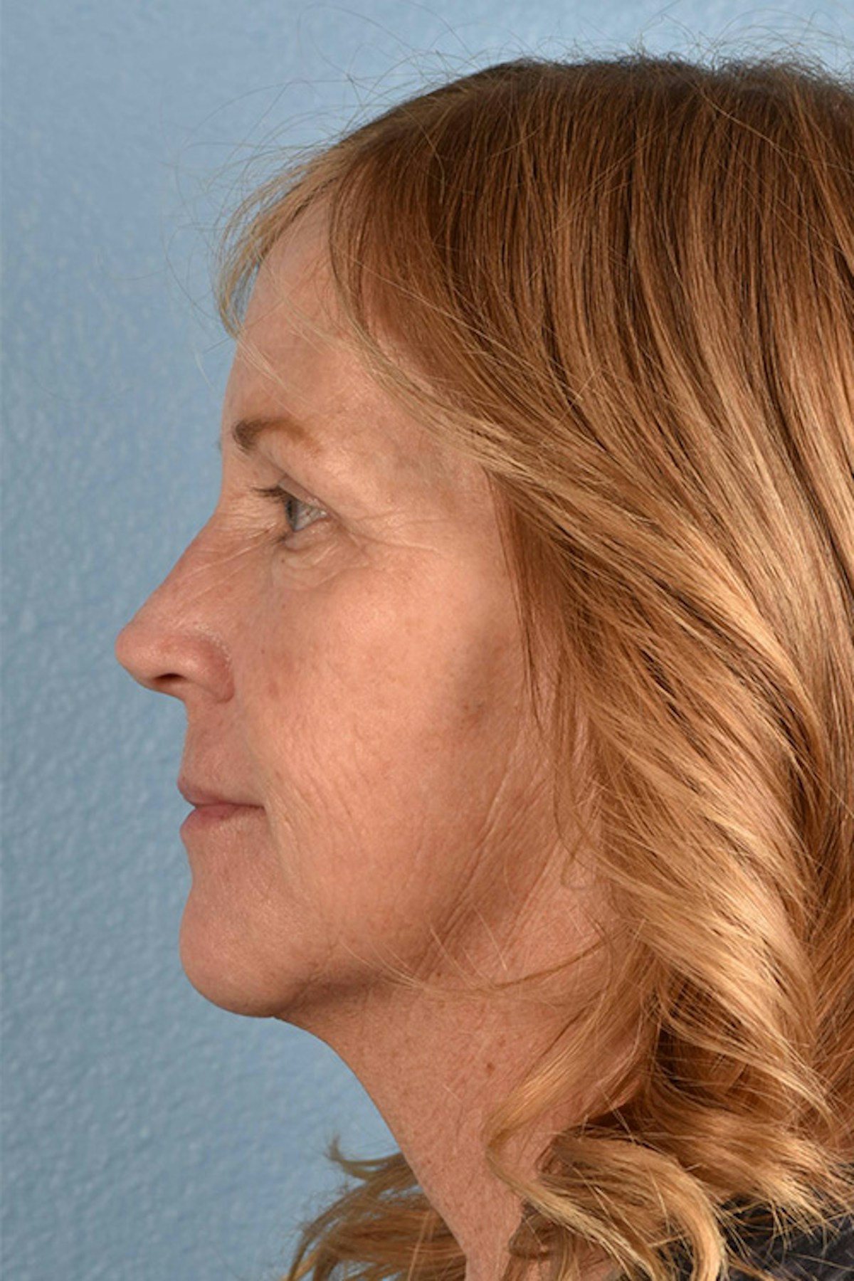 Blepharoplasty Before & After Gallery - Patient 943759 - Image 4