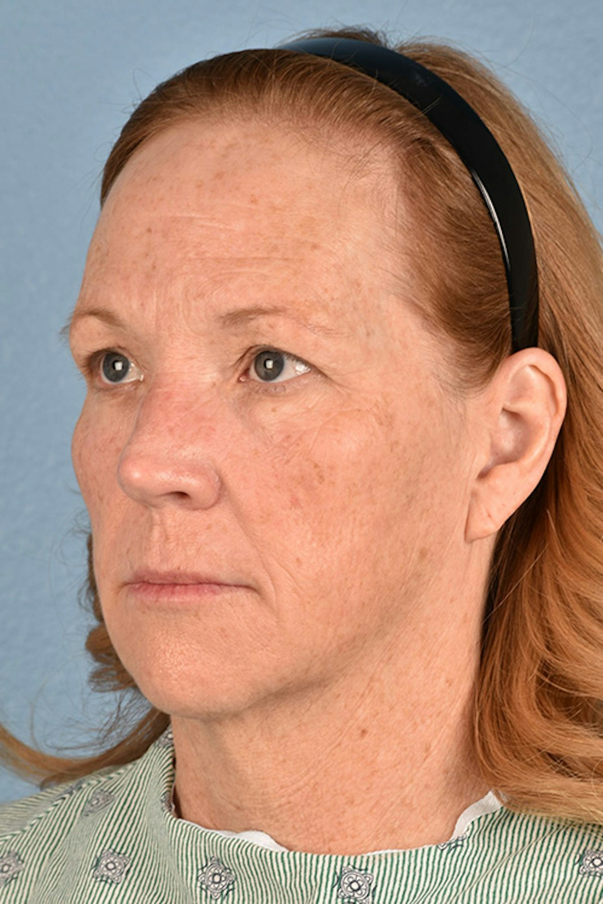 Blepharoplasty Before & After Gallery - Patient 943759 - Image 5
