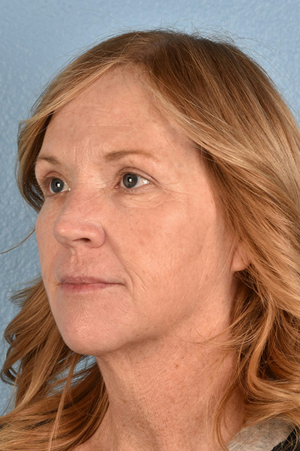 Blepharoplasty Before & After Gallery - Patient 943759 - Image 6