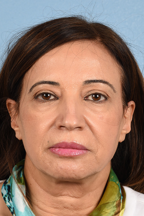 Hidden Patients Before & After Gallery - Patient 170701 - Image 1