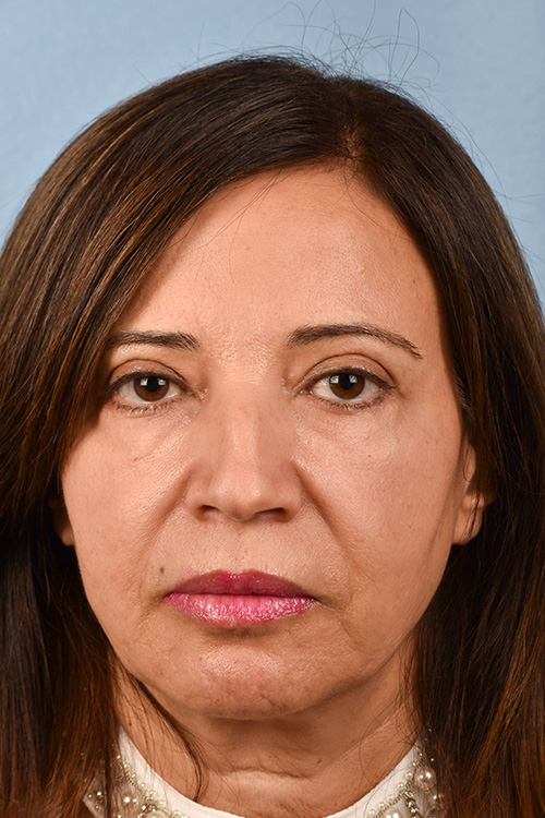 Hidden Patients Before & After Gallery - Patient 170701 - Image 2