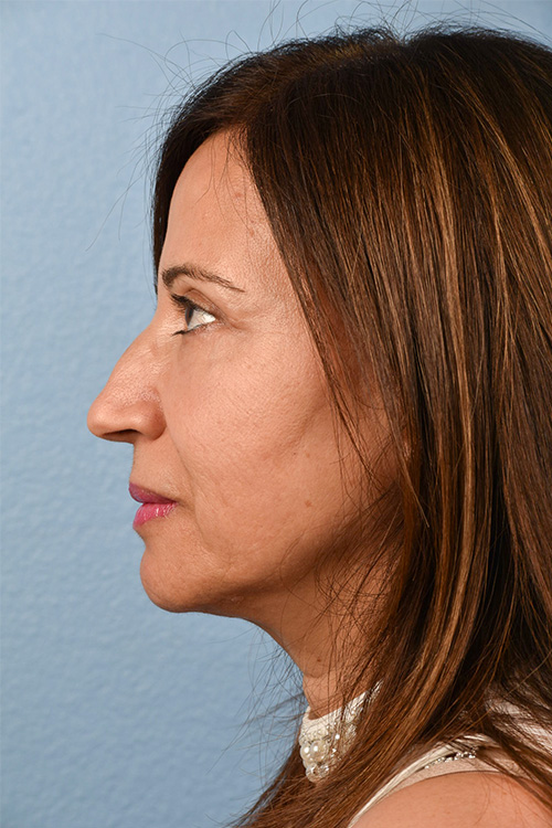 Hidden Patients Before & After Gallery - Patient 170701 - Image 4