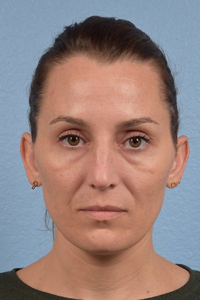 Blepharoplasty Before & After Gallery - Patient 117445 - Image 1