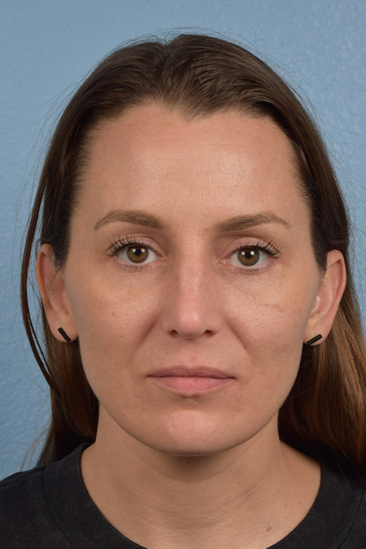 Blepharoplasty Before & After Gallery - Patient 117445 - Image 2