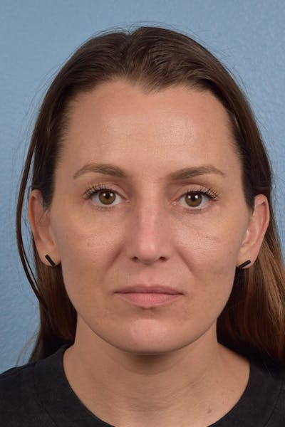Blepharoplasty Before & After Gallery - Patient 117445 - Image 2