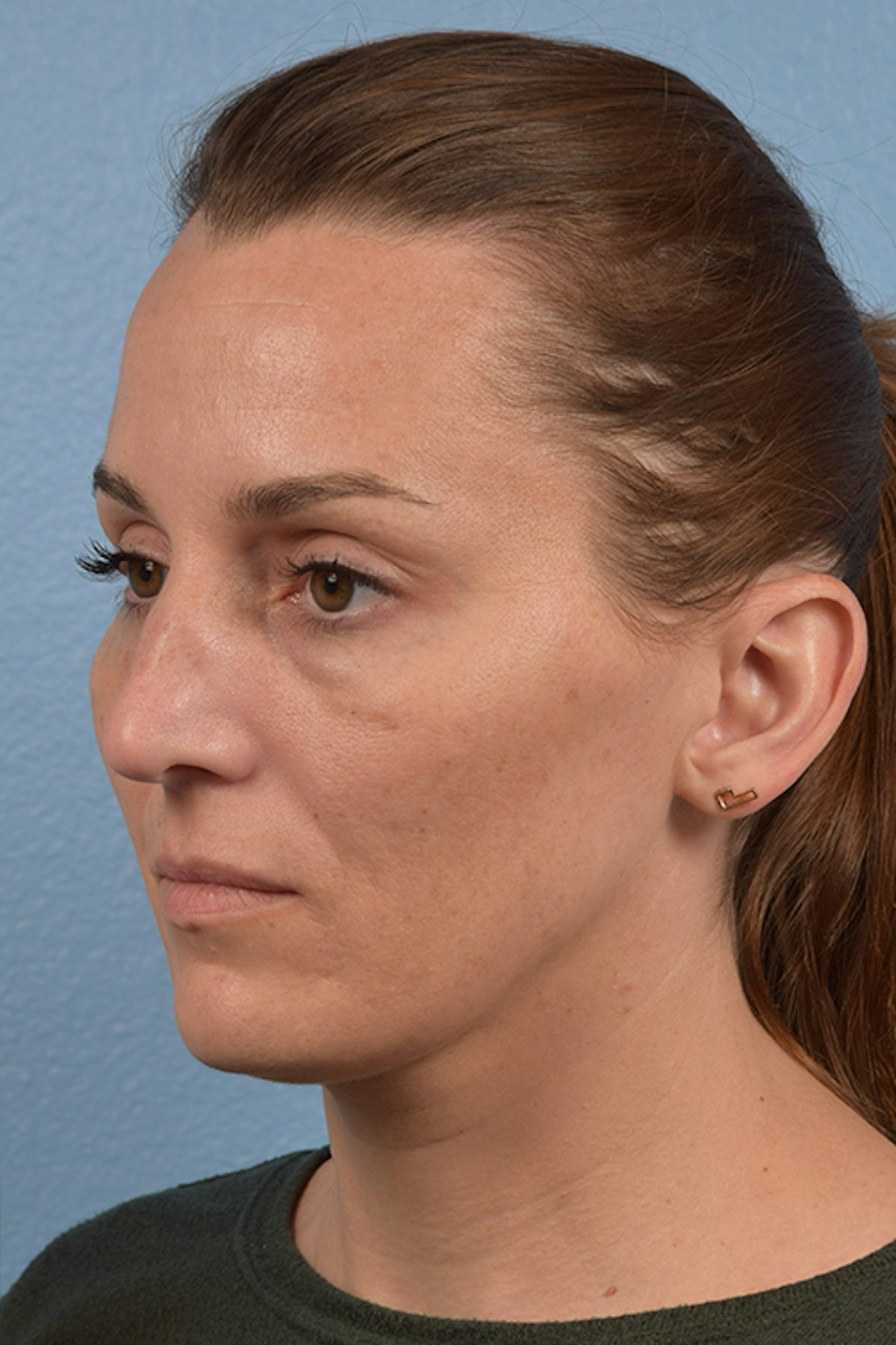 Blepharoplasty Before & After Gallery - Patient 117445 - Image 3