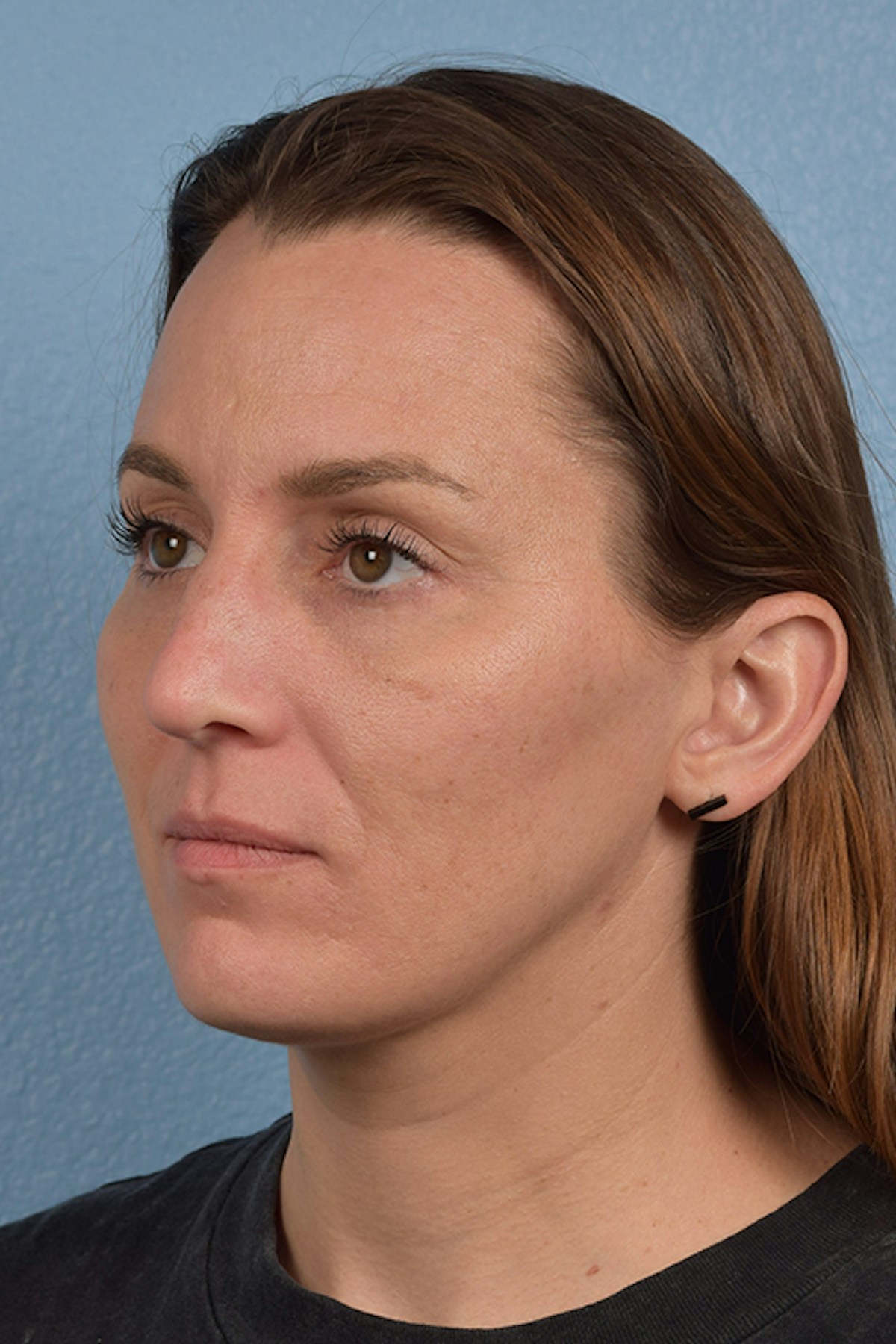 Blepharoplasty Before & After Gallery - Patient 117445 - Image 4