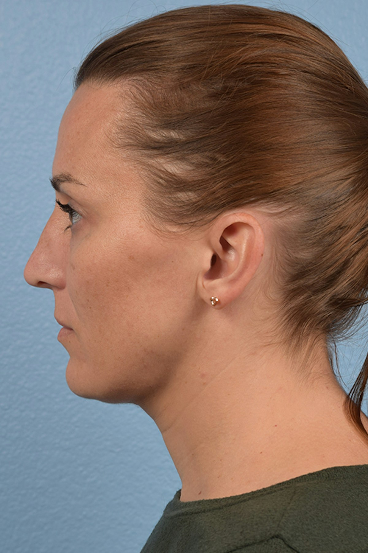 Blepharoplasty Before & After Gallery - Patient 117445 - Image 5