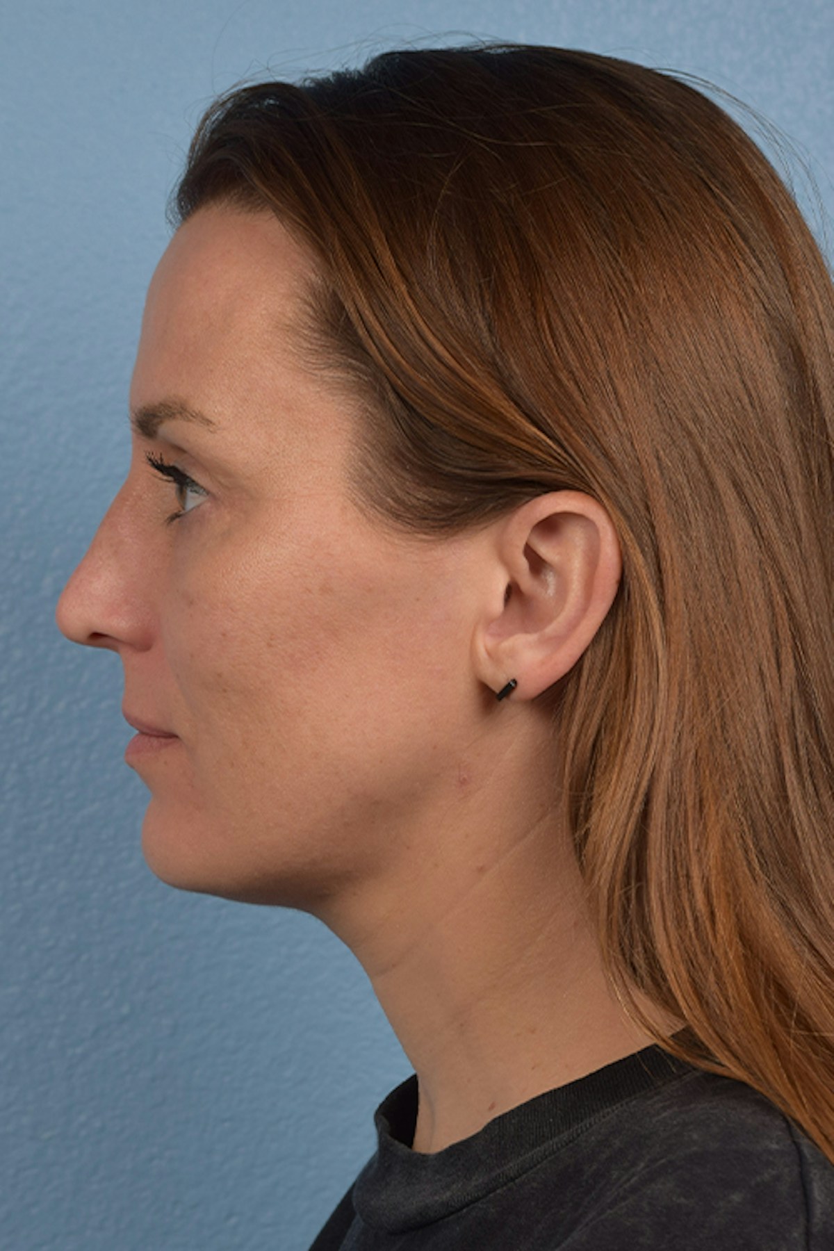 Blepharoplasty Before & After Gallery - Patient 117445 - Image 6