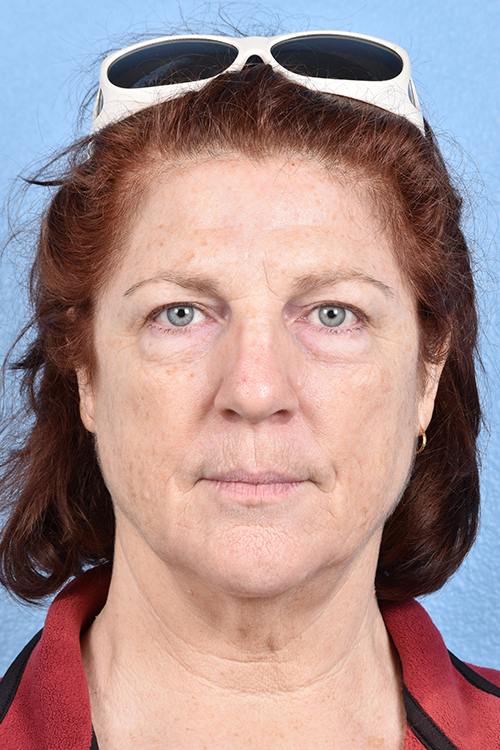 Hidden Patients Before & After Gallery - Patient 100587 - Image 1