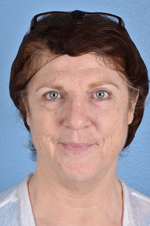 Hidden Patients Before & After Gallery - Patient 100587 - Image 2