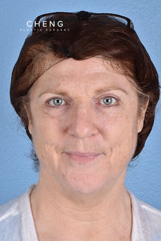 Hidden Patients Before & After Gallery - Patient 100587 - Image 2