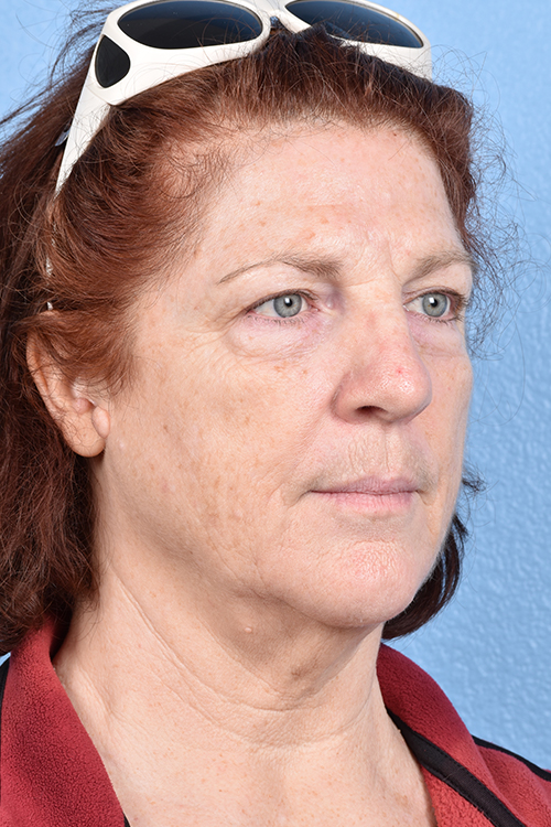 Hidden Patients Before & After Gallery - Patient 100587 - Image 3