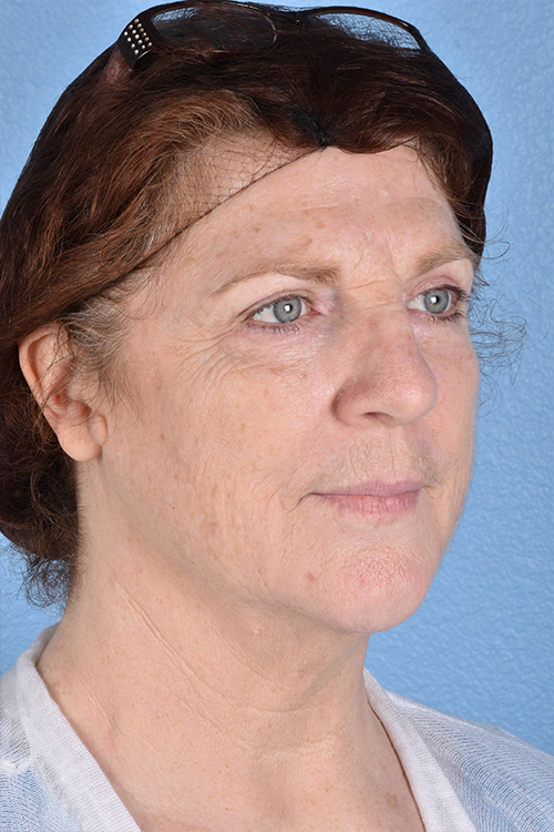 Hidden Patients Before & After Gallery - Patient 100587 - Image 4