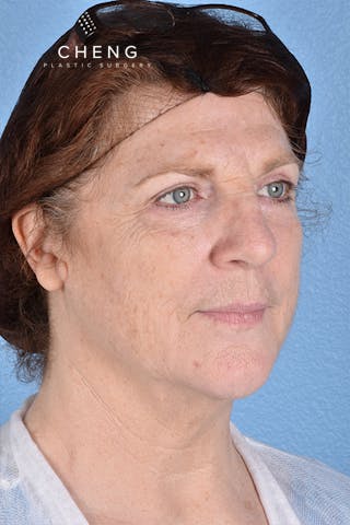 Hidden Patients Before & After Gallery - Patient 100587 - Image 4
