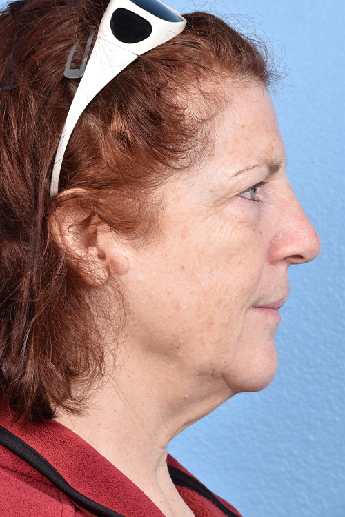 Hidden Patients Before & After Gallery - Patient 100587 - Image 5