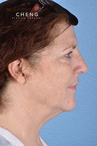 Hidden Patients Before & After Gallery - Patient 100587 - Image 6